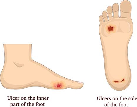 Diabetic Foot Symptoms | Ulcers on Foot